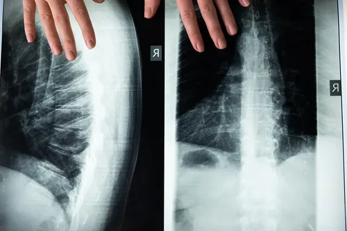 Spinal imaging used in treatment planning
