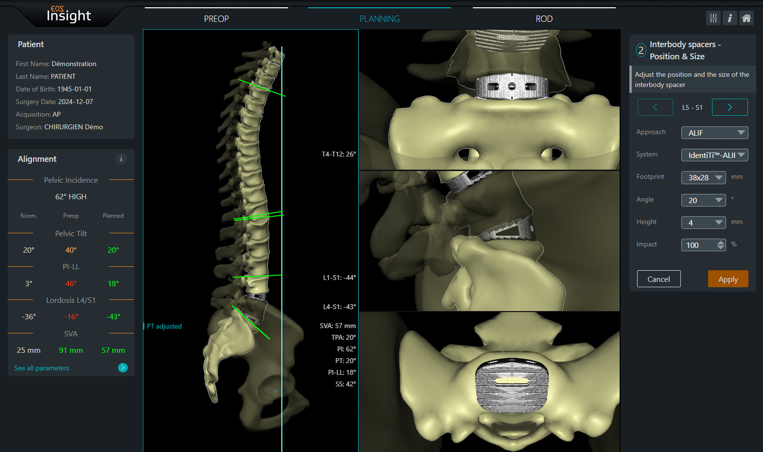 Manufacturer demonstration of EOS Insight showing a 3D spine model, alignment measurements, and surgical planning views